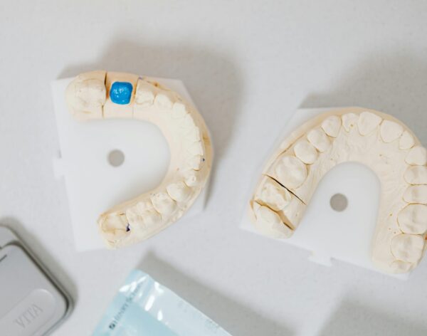 Crowns, bridges, and onlays